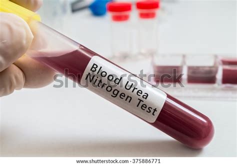 287 Blood Urea Nitrogen Royalty Free Images Stock Photos Pictures