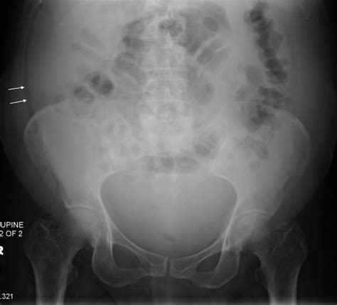 Ascites Xray MyBioSource Learning Center