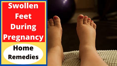 Swollen feet during pregnancy edema natural remedies – Artofit