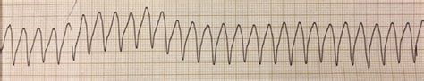 Dr. Smith's ECG Blog: Pulseless ventricular tachycardia – why did the AED not advise a shock?