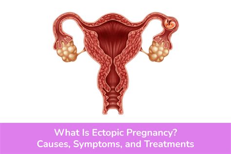 What Is Ectopic Pregnancy? Causes, Symptoms, And Treatments