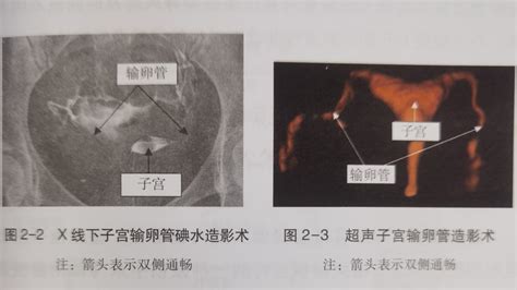 有问题就有答案丨第6节不孕不育症系列输卵管通畅性检查有哪些如何选择