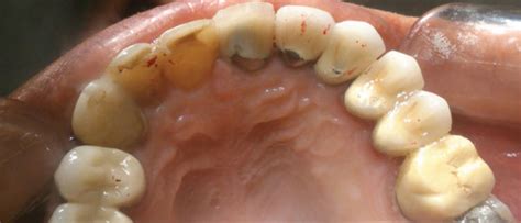 Occlusal View Of Pfm Crowns For Upper Left Lateral Canine And