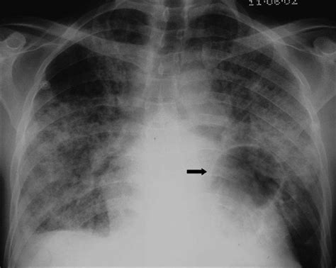 Pneumocystis Carinii Pneumonia If Left Untreated Chest X Ray May Download Scientific Diagram