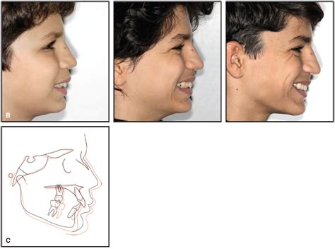 Aligner Corner Jco Online Journal Of Clinical Orthodontics