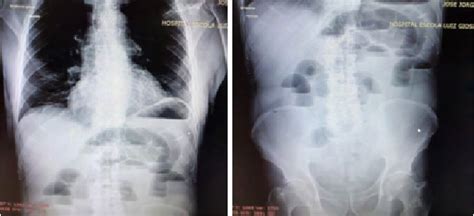 Figure 1 from INCARCERATED LITTRÉ S HERNIA A CASE REPORT Semantic