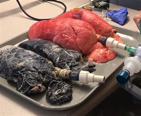 Video Shows Difference Between Healthy Lungs And Smokers Lungs