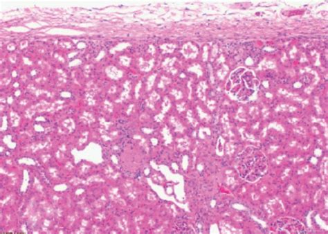 Ad The Micrograph Of A Clear Cell Renal Cell Carcinoma H E Stain