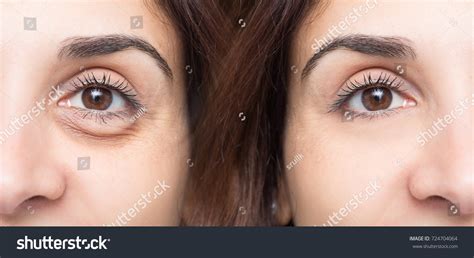 Woman Eye Before After Cosmetic Treatment Stock Photo (Edit Now) 724704064