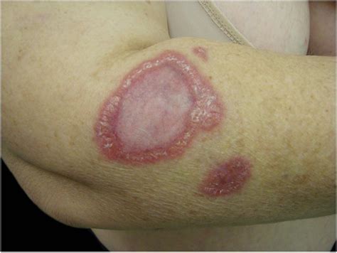 Scielo Brasil Cutaneous Manifestations Of Bartonellosis Cutaneous