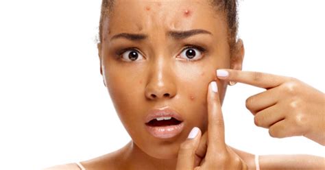 Pele Espinhas Mentiras E Verdades Sobre Acne E Cuidados De