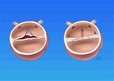 Bicuspid Aortic Valve Disease Cardiac Health