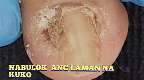 Mabaho Ang Nabulok Na Ingrown Sa Loob Ng Kuko Youtube