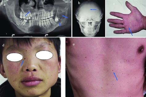 Basal Cell Nevus Syndrome