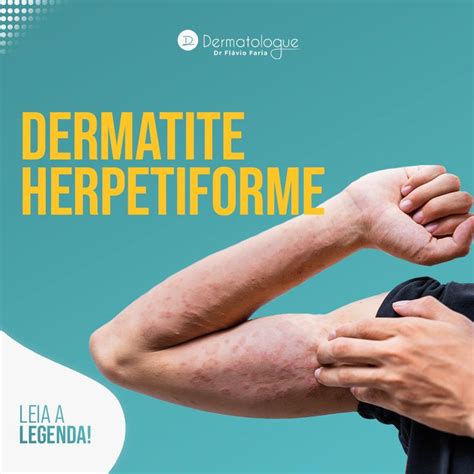 Dermatite Herpetiforme Um Tipo De Erup O Cut Nea Cr Nica Ela