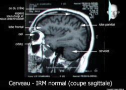 Cerveau IRM Coupe Sagittale Anatomie Photo Et Illustration