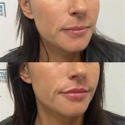 Lip Injection Before After Gallery Artofit