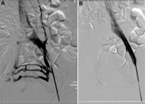 Venograms Of The Left Iliac Occlusion And Collateral Veins Before A Download Scientific