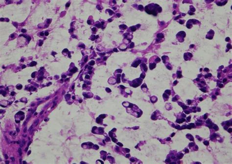 Primary Signet Ring Cell Carcinoma Of The Cervix About An Uncommon