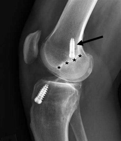 Anterior Cruciate Ligament Reconstruction Surgery