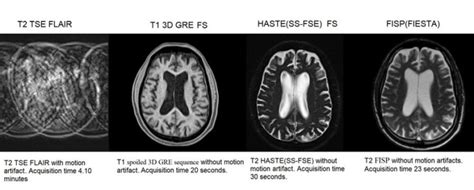 MRI Artifacts MRI Motion Artifact Ghosting Artifact Mri