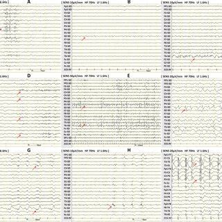 Example Of The Characteristic Interictal Scalp EEG Patterns Of FCD A