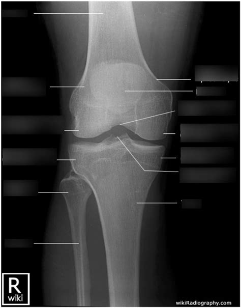 Knee AP Labelling Diagram Quizlet