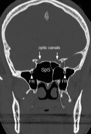 Sphenoid Sinus Normal Anatomy And Variants