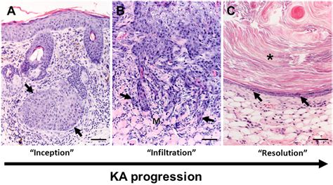 Keratoacanthoma Histology