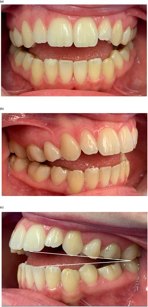 Point Counterpoint Conventional Jaw Surgery Versus The Surgery First