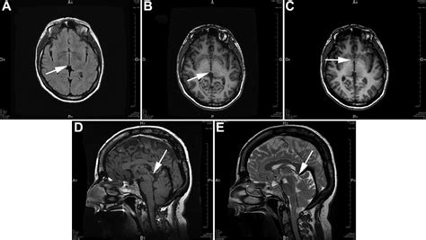 Abnormal Brain Mri