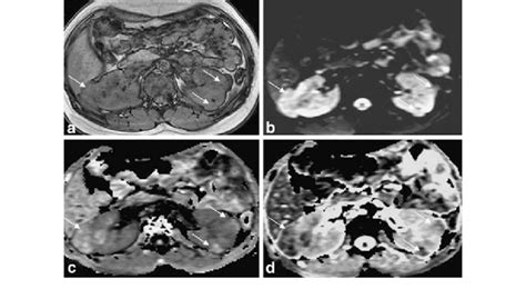 Multiple Renal Angiomyolipomas In A 16 Years Old Girl A T1wi In Phase