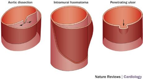 Acute Aortic Syndrome Subtypes A Aortic Dissection With An