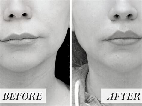 How To Reduce Big Lips Without Surgery - Infoupdate.org