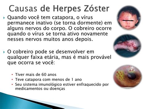 O Que Causa Herpes No Corpo - PPT - Herpesvírus PowerPoint Presentation, free download - ID:2138084
