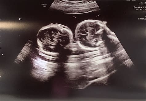 21 Weeks Pregnant With Twins Ultrasound