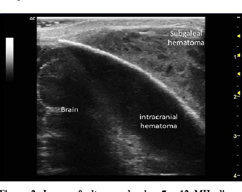 Subarachnoid Space Hemorrhage Ultrasound