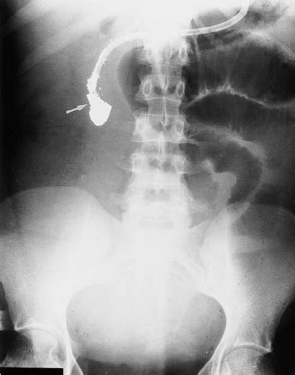 31 Year Old Woman With Post Operative Ileus Mimicking Small Bowel