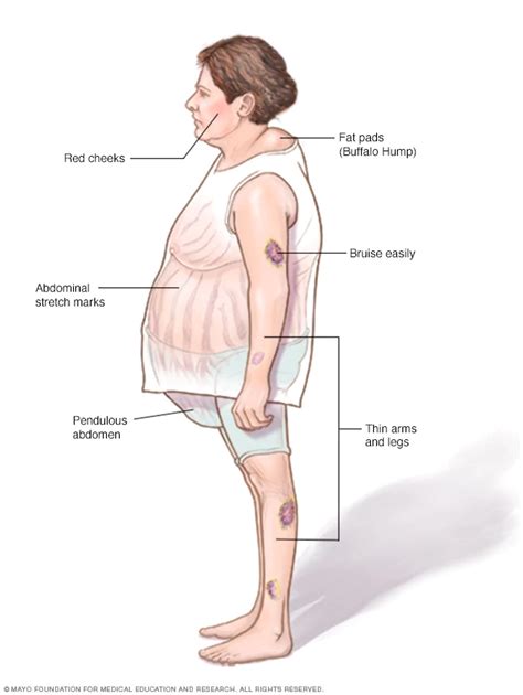 Cushing Syndrome Symptoms And Causes Mayo Clinic Cushings