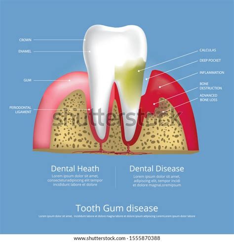 Human Teeth Stages Gum Disease Vector Stock Vector Royalty Free