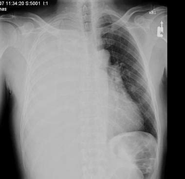 Chylous Pleural Effusion