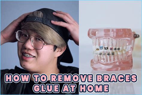 How To Remove Braces Glue At Home - The Easy Way! - The Mocracy