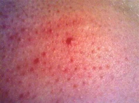 HealthoolRash in Celiac disease Rash Pictures Atlas of Rashes ...