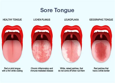 What Causes Thick Yellow Coating on the Tongue - Traditional Chinese Medicine Ha