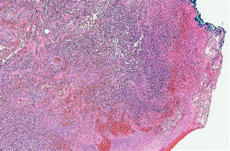 Ecthyma Gangrenosum Histology