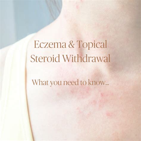 Eczema Topical Steroid Withdrawal Balance Skin And Wellness Clinic