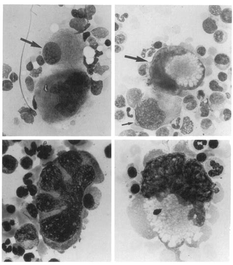 Upper Right Large Mononuclear Megakaryocyte Small Arrow And