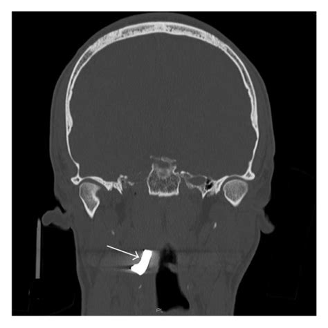 Axial A Coronal B And Sagittal C Ct Scans Of The Head And Neck