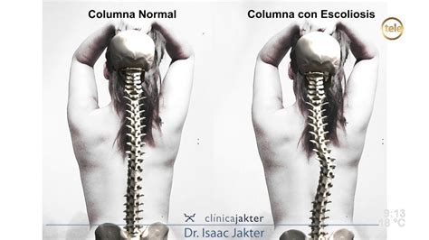 Escoliosis Desviaci N Lateral De La Columna Dr Isaac Jakter Youtube