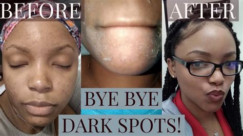 How To Get Rid Of Dark Spotsacne Chemical Peel Youtube